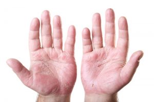 How to Treat Psoriasis on Your Hands